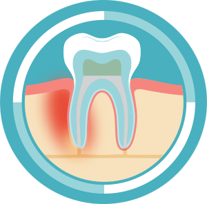 Root Canal before Treatment: A diagram showing infection in the tooth tissue