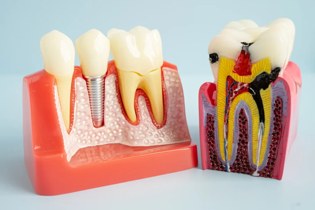 Dental implant model beside a cross-section model of a decayed tooth with an infected pulp